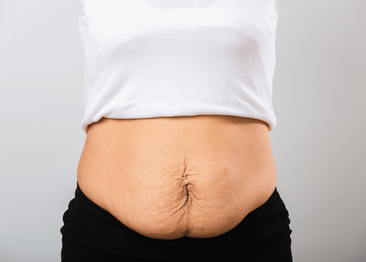 How to Tighten Loose Skin on Stomach Without Surgery